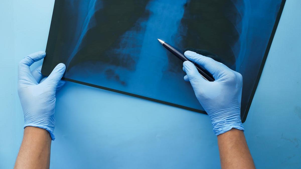 Polmonite interstiziale, cos’è la malattia che ha colpito Vessicchio