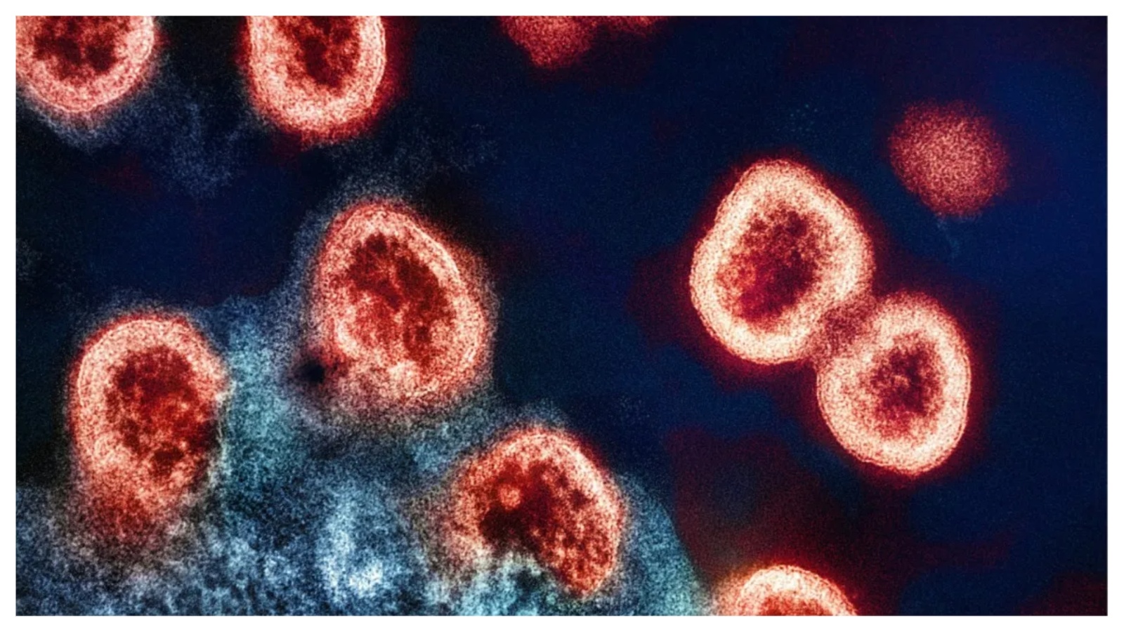 Focolaio meningite Inghilterra